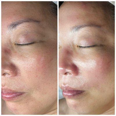 The power of Glo2 Facial!