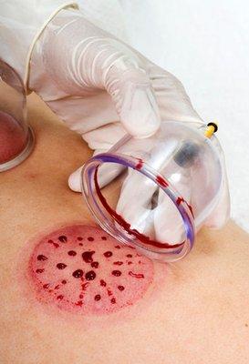 Hijama