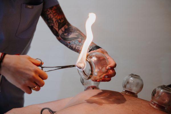 Fire cupping therapy