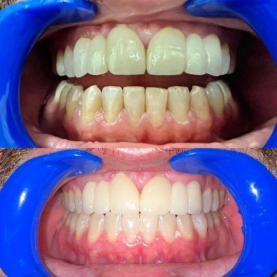 Before & After a 60 mins teeth whitening procedure