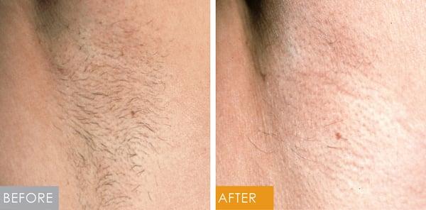 Forget about shaving or waxing after 6 sessions with our TRUELY PAINLESS laser hair removal treatment.