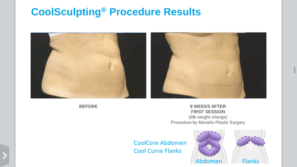 Coolsculpting of the abdomen by Moraitis Plastic Surgery