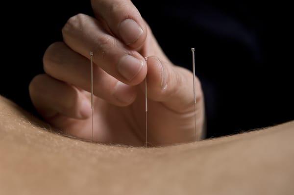 Needling