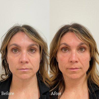 Undereye Filler