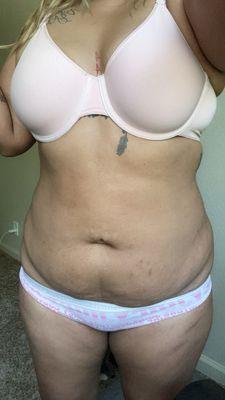 Front view after my first lipo injections