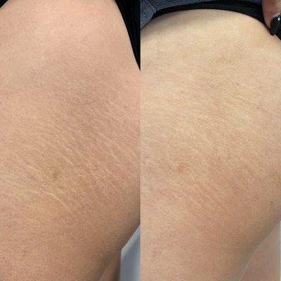 Results after one session of our stretch mark treatment. Dm for a consultation to see which treatment works best for you