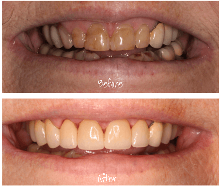 6 front crowns for this patient! Giving our patient a fresh new smile after years of wear and tear