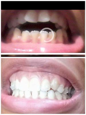 Before (top) after (bottom) open bite. Invisalign