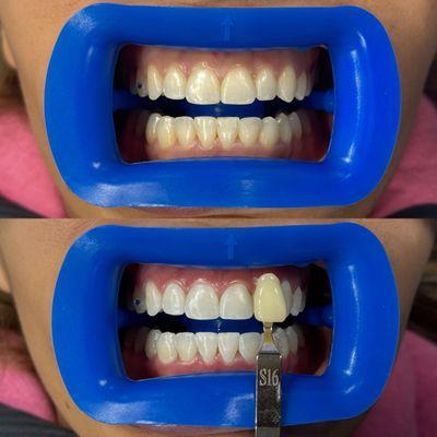 Before and after teeth whitening results.