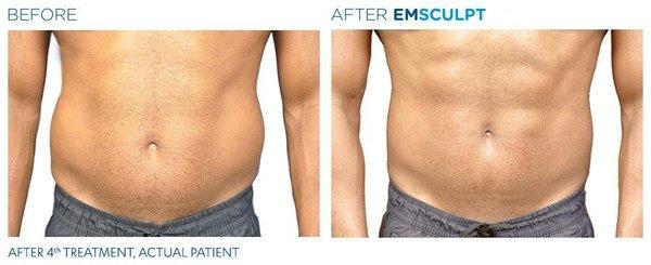 Toned Abs with EMSCULPT