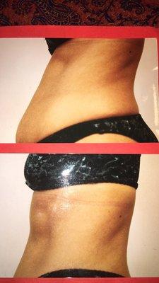 Italian body toning and cellulite melting 10 sessions  No down time 3xs for 5 weeks $1000. (Reg $2000) Toned and trim for a New Year