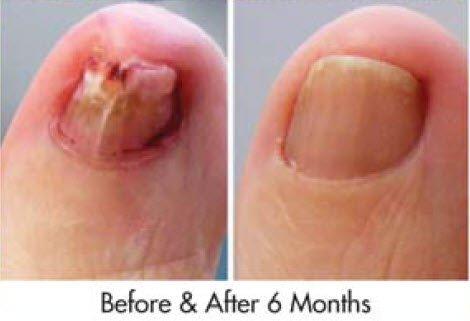 Laser toenail treatment