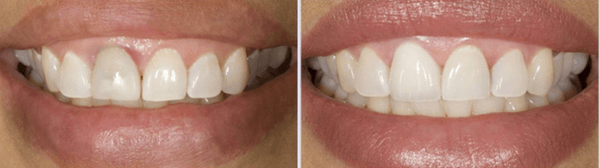 Replacement Crowns to All Porcelain