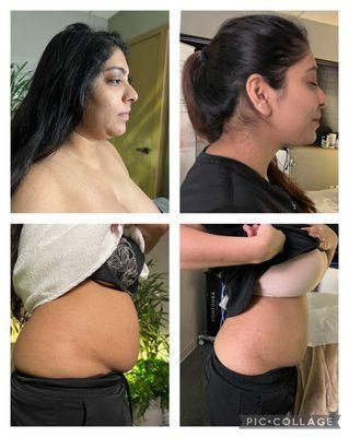 Body FX with Hifem and Accufit for belly and MiniFX for double chin