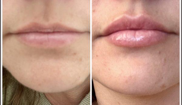 Before and after lip filler.