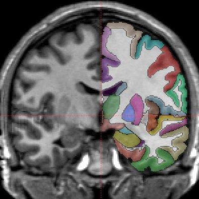 Neuroanatomically (half) labeled brain scan