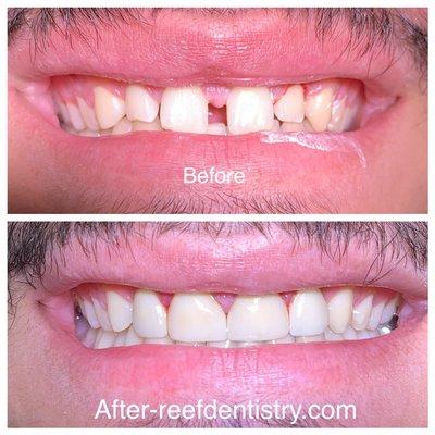 Cosmetic crown case completed by Dr. Kile Sherry