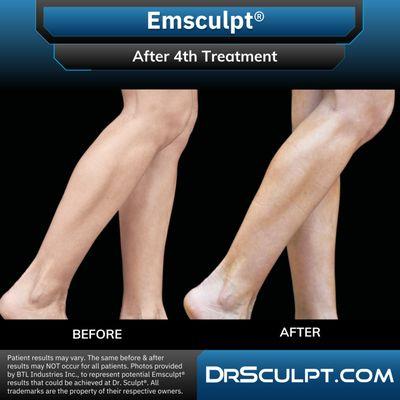 After 4th CoolSculpting treatment on calves