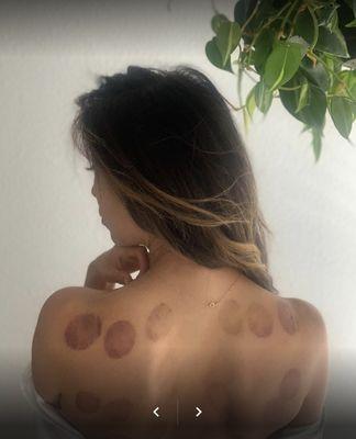 Fire Cupping