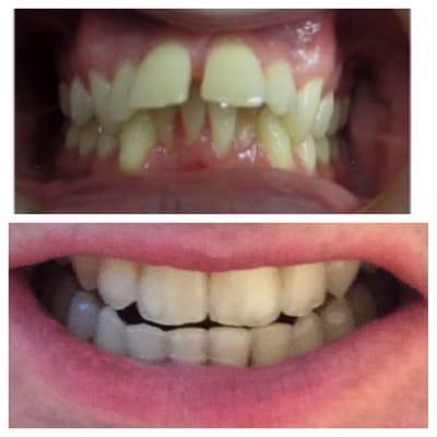 Before and after shot. Adult who needed but never had braces as a child. 23 months on top. 20 months on bottom.