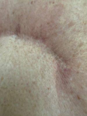 My back close up- I had Ceroma several times. This is where Paul smith squeezed the fat from my back to place in my breast.-