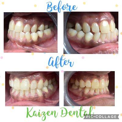 Upper jaw expansion with orthodontic treatment allowed us to correct the bite, improve breathing and esthetics at the same time.