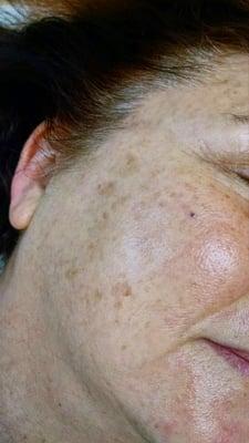 Before - hyperpigmentation