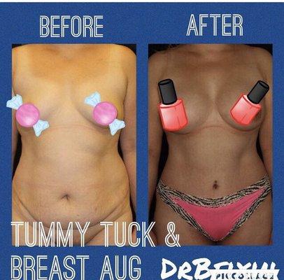 6 months post op Tummy Tuck and Breast Augmentation by Dr Blyer