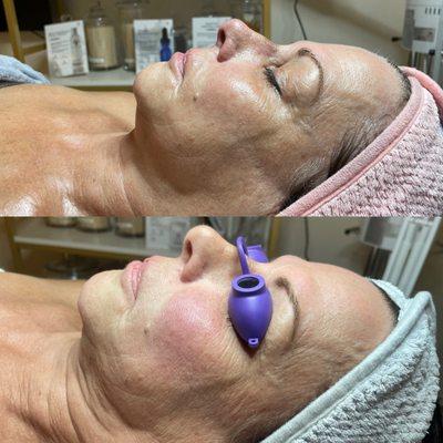 Micro current facial