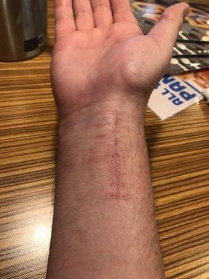 About two months after surgery... such a great surgeon. Look at how perfectly the scar is healing!