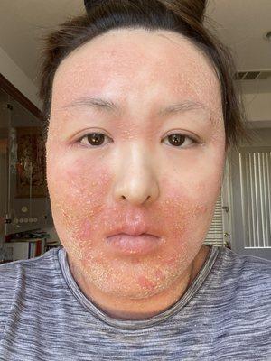 skin purging after a few naet treatments