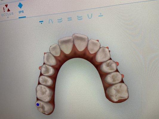 My top teeth after