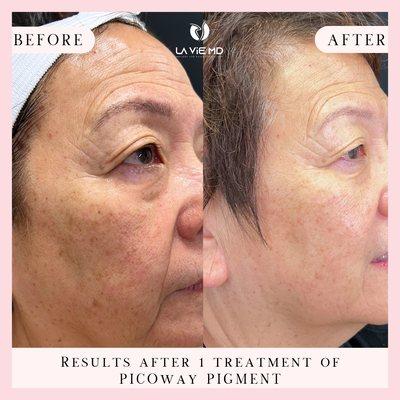 Say bye-bye to hyperpigmentation and dark spots. 
Amazing results after one treatment with Picoway.