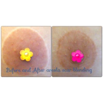 Before and after areola scar camouflage post breat augmentations and lift