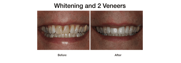 Before and after Teeth Whitening and 2 Veneers