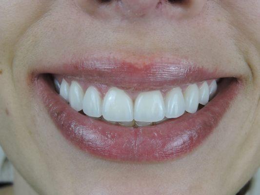 Veneers