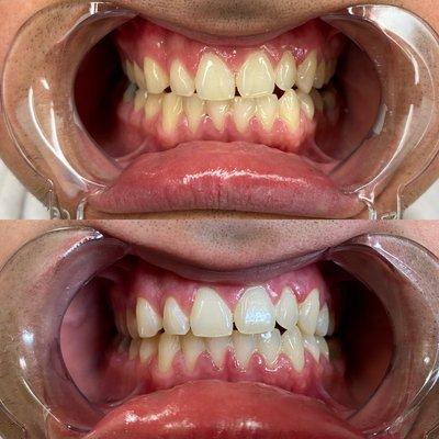 Cosmetic teeth whitening $99