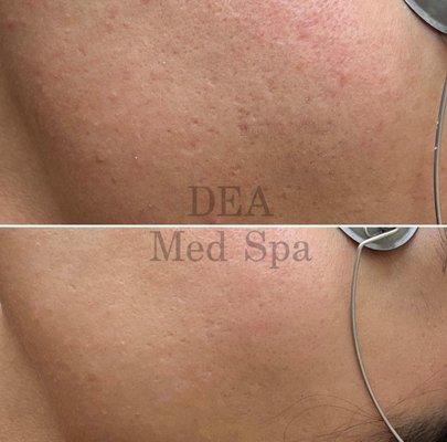 Laser Skin Resurfacing 
for the treatment of:
* pitted acne scars
* large pore size
* rough skin texture
* uneven skin tone