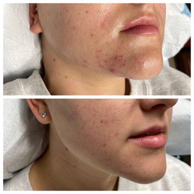 Acne Treatment with PRP