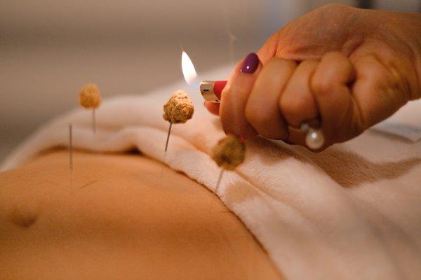 Moxibustion