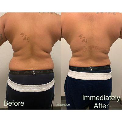 Hourglass treatment - side / back results after one session.