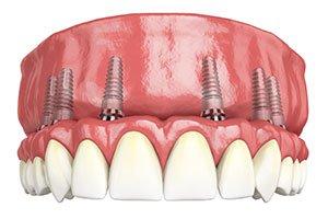 Implant supported teeth can be done in as little as 24 hours and get you back to eating all the foods you love.