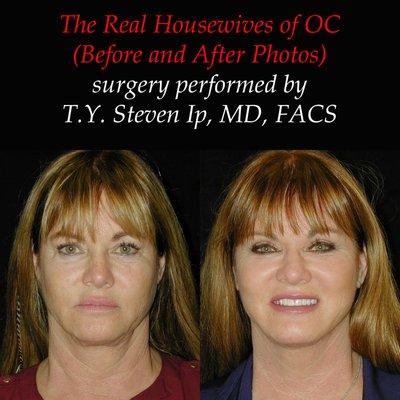 The Real Housewives of OC (RHOC) surgery with T. Y. Steven Ip, MD, FACS