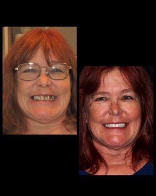 Smile Makeover