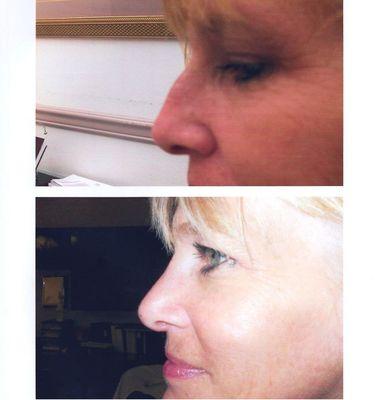 Rhinoplasty by our plastic surgeon, Dr. Paul Dreschnack