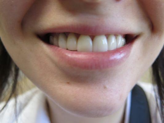 Veneers