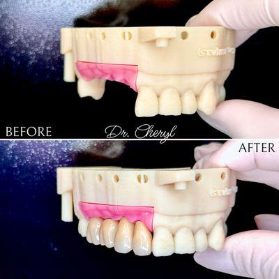 Dental implants, now our patient can smile and chew food comfortably