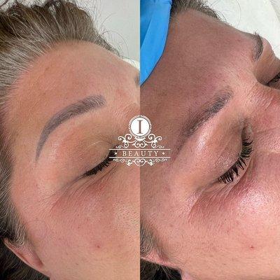 Eyebrow Laser Removal. Client had her eyebrows Microbladed and did not want the hair strokes anymore. We did one session of removal on her