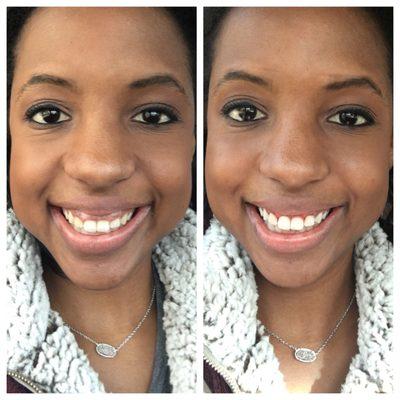 Before/after gum contouring on the same day. No stitches. Of course it looks even better fully healed.