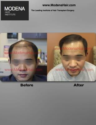 Results after 1 Hair Transplant Procedure In Asian Patient